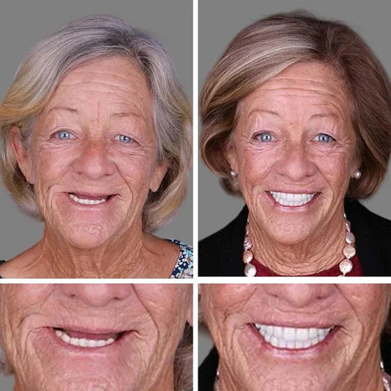 '--Ends Today: 75% OFF! ⏰DarkFairy™ Medical Full Denture with Strong Suctiond Custom-Fit Full Functional Dentures🦷